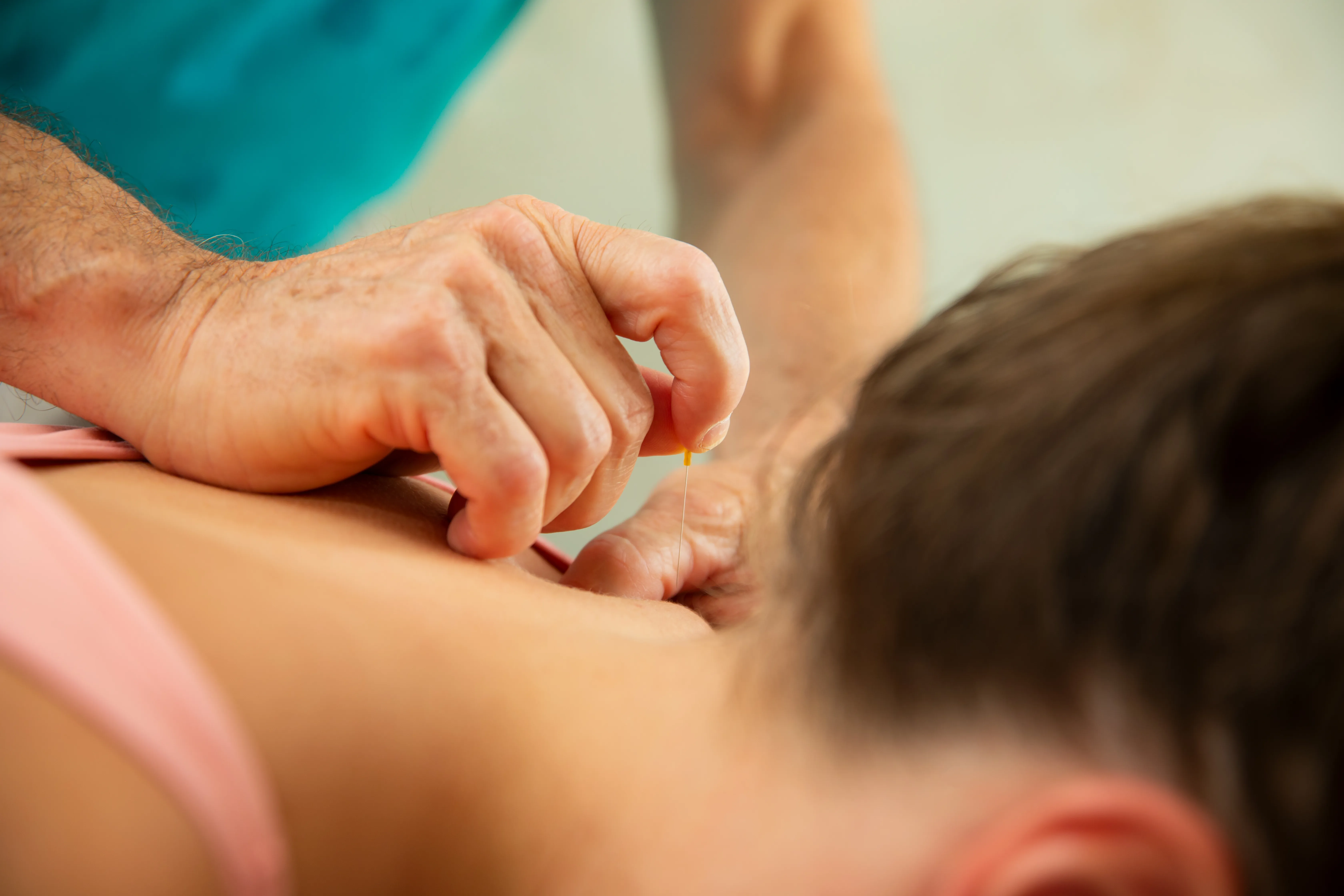 Nahaufnahme einer Akupunkturbehandlung am Nacken.