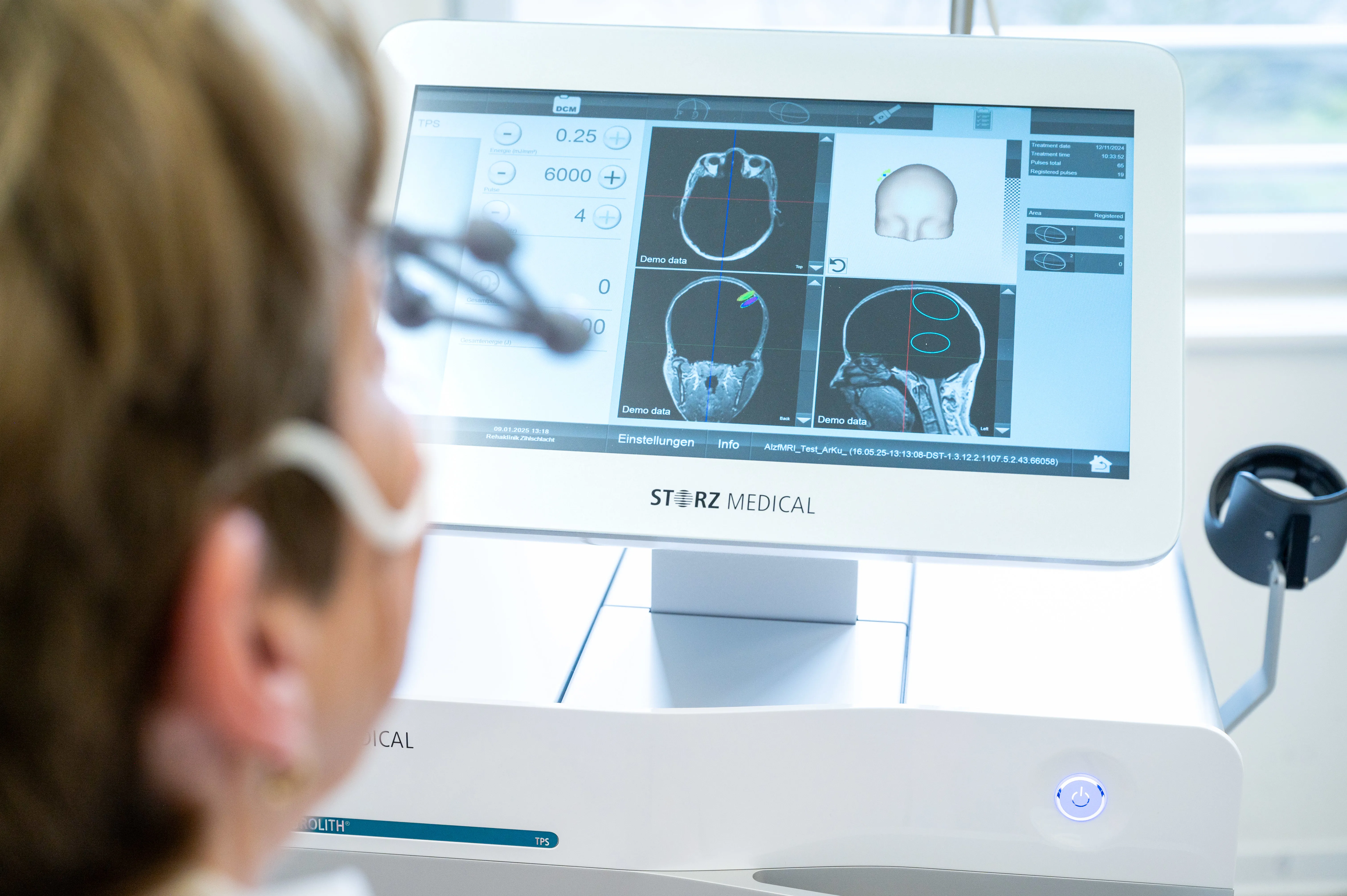 Bildschirm mit Aufnahmen des Kopfes während der TPS Therapie.